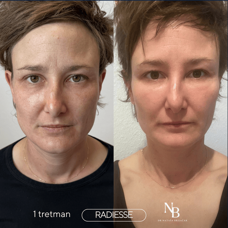 Slika: Radiesse tretman