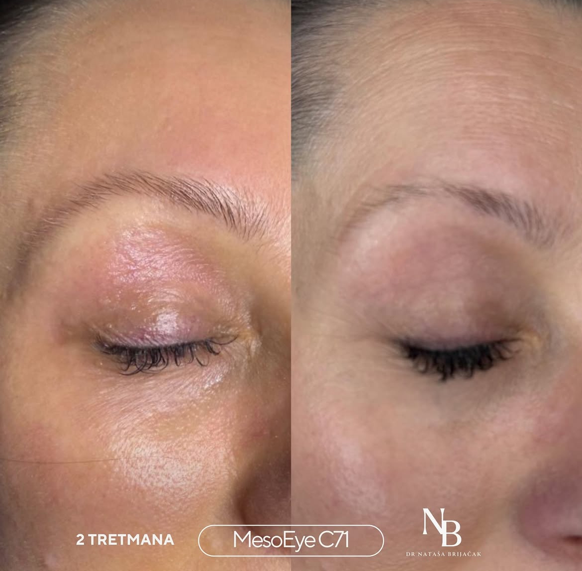 MesoEye C71 - 2 tretmana