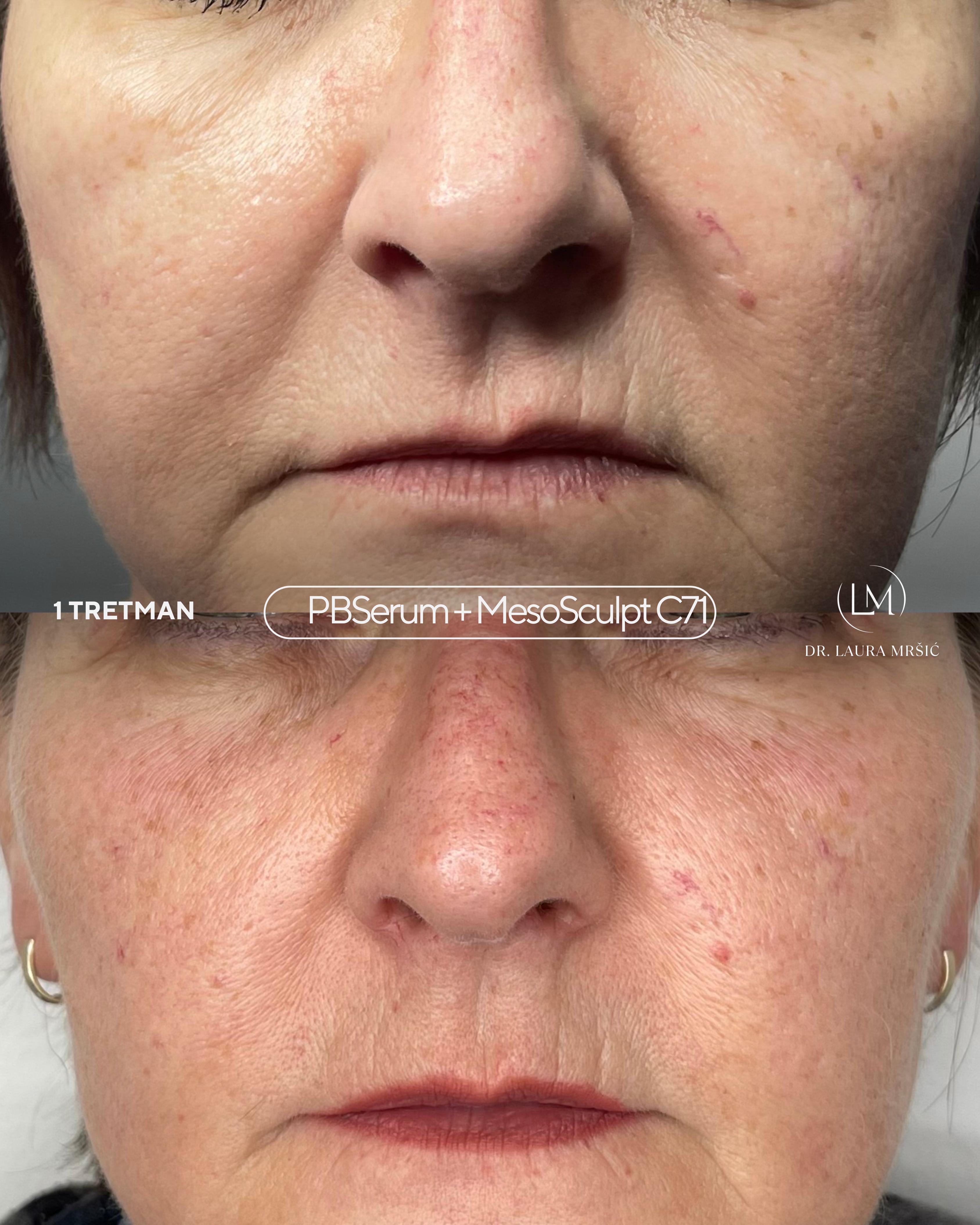 MesoSculpt C71 – konture lica, podbradak (1 tretman + PBserum 1 tretman)