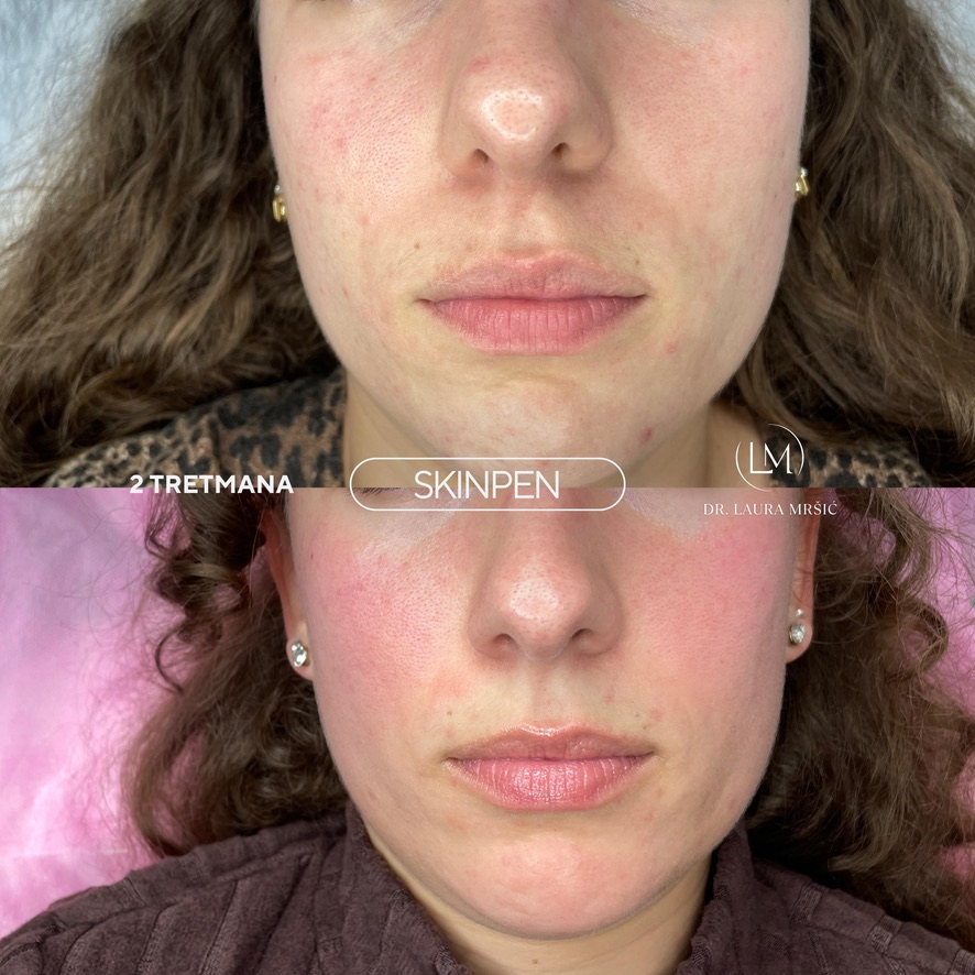 SkinPen mikroneedling