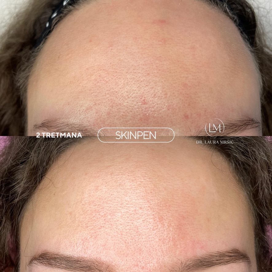 SkinPen mikroneedling