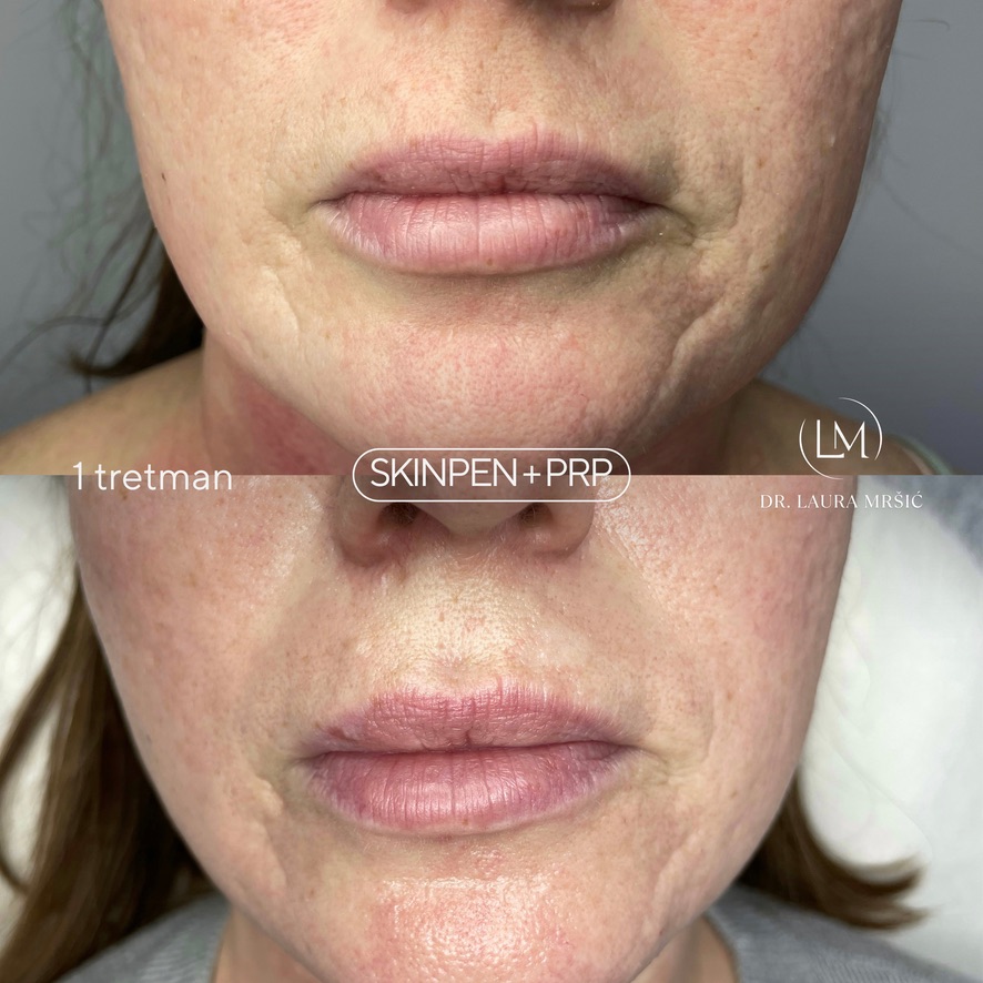 SkinPen mikroneedling