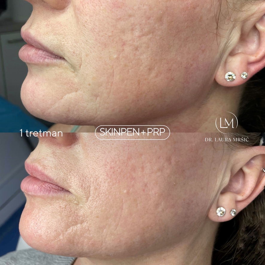 SkinPen mikroneedling