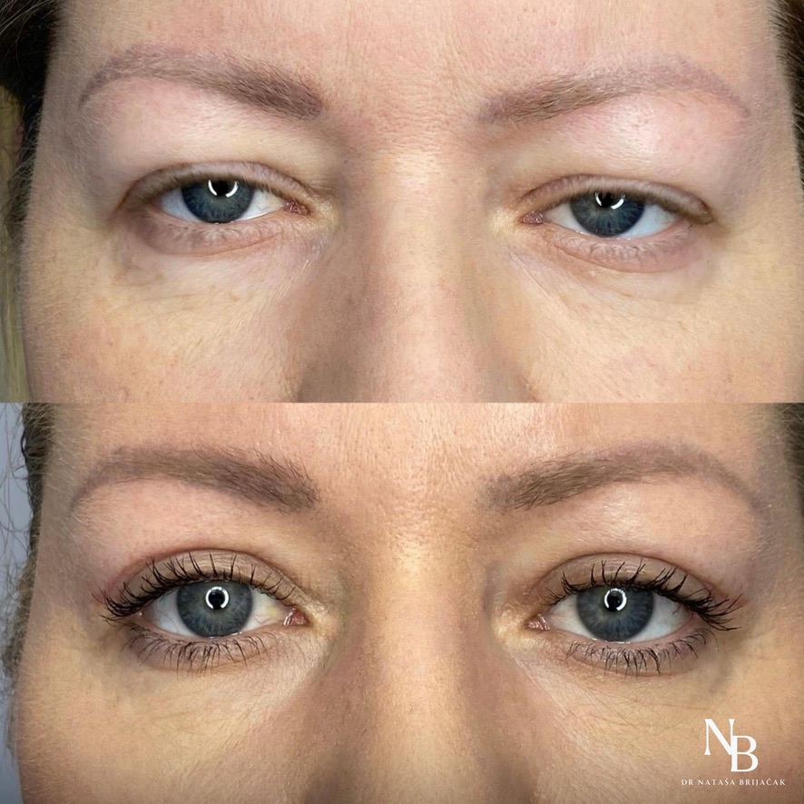 Operacija gornje blefaroplastike