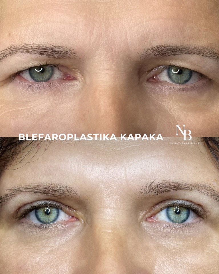 Operacija gornje blefaroplastike